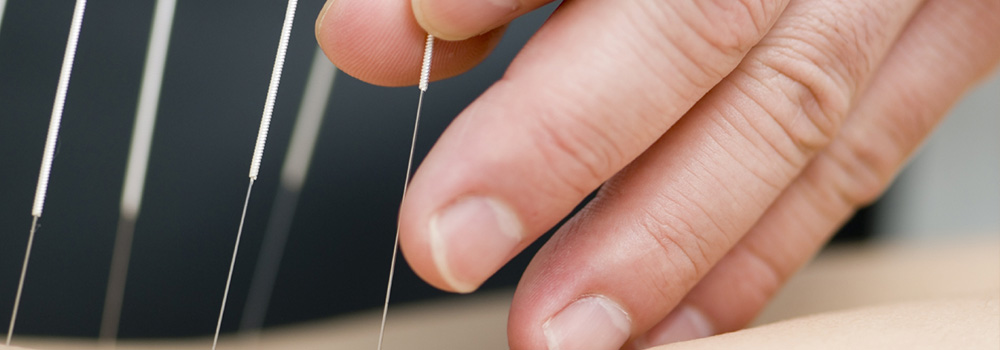 Physiotherapist during an accupuncture precedure with a patient